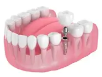 抜けたままの歯がある